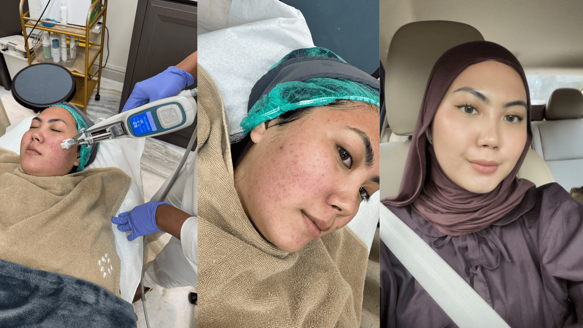 Review Pertama Kali Cobain DNA Salmon Micro Injection di ZAP Premiere,  Intip Hasilnya Setelah 2 Minggu!