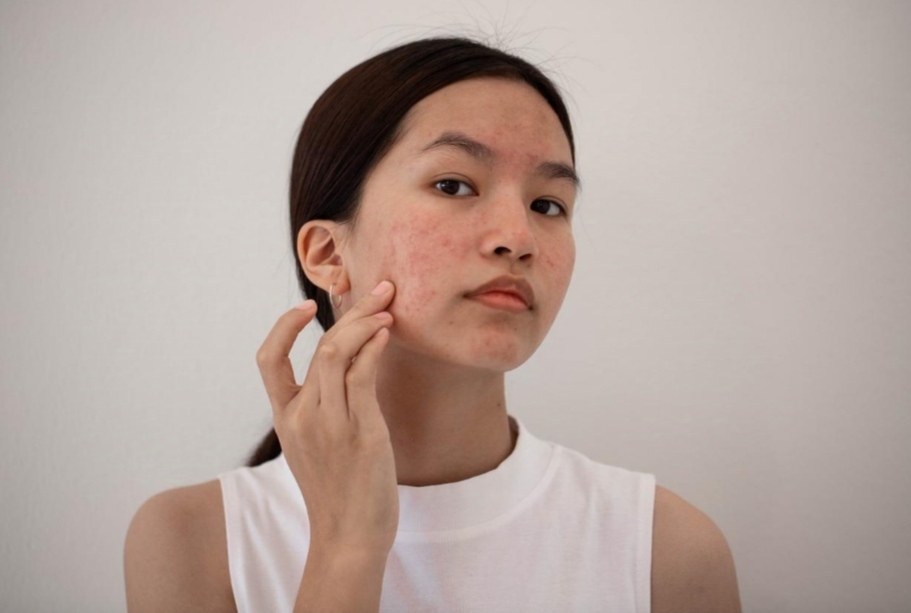 WAJIB CATAT! Ini 3 Tips Memilih Sunscreen untuk Kulit Berjerawat!