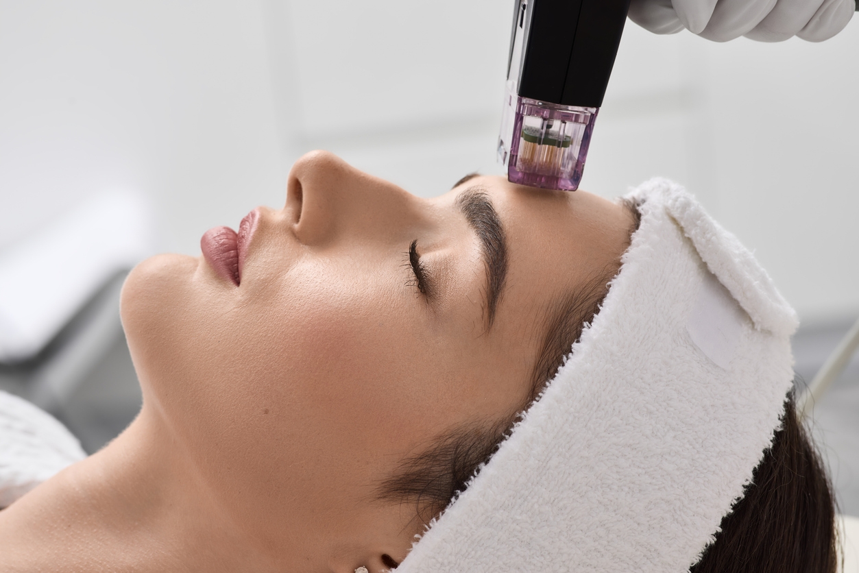 5 Treatment Bekas Jerawat dan Hiperpigmentasi di Klinik, Mana yang Cocok Buatmu?