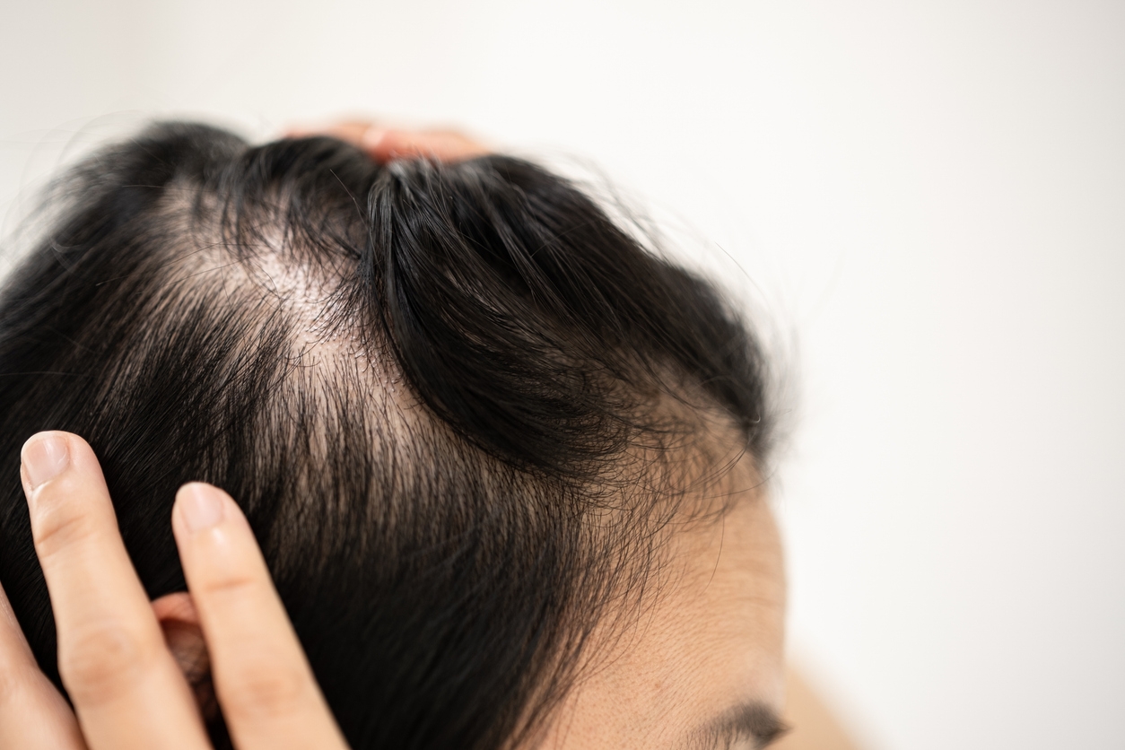 Sering Ganti Belahan Rambut, Benarkah Bisa Cegah Rambut Menipis?